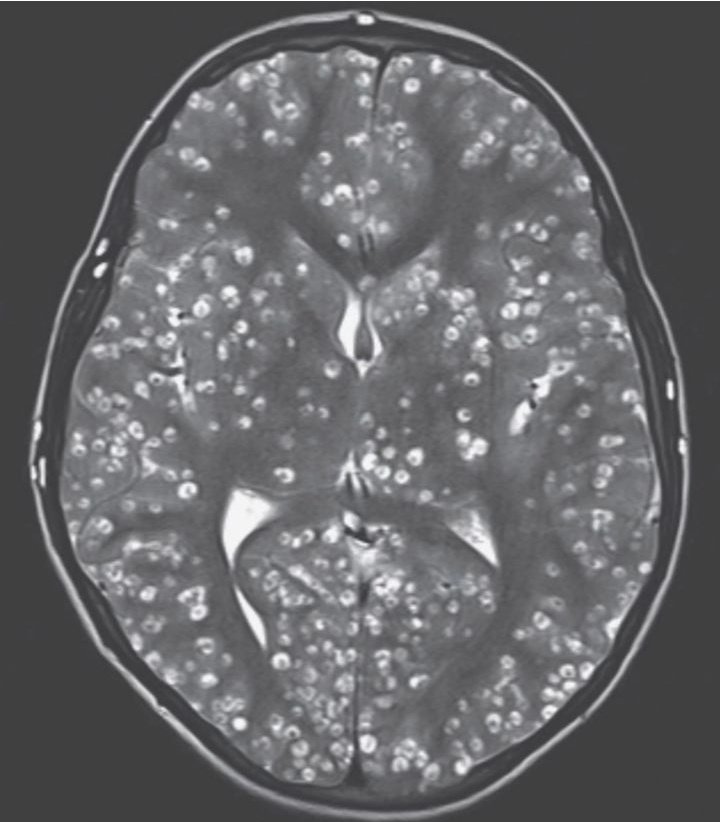 🟣𝘾𝙇𝙄𝙉𝙄𝘾𝘼𝙇 𝙎𝘾𝙀𝙉𝙀𝙍𝙄𝙊:-

📝A 28yr old male p/w tonic clonic #seizures in ED,Few days ago he eaten meal from restaurant .MRI shows #cystic lesions.

Diagnosis ❓❓

A) Neurocysticercosis 
B) Metastasis 
C) Neurosyphilis 
D) Multiple Myeloma

#medx
#medEd