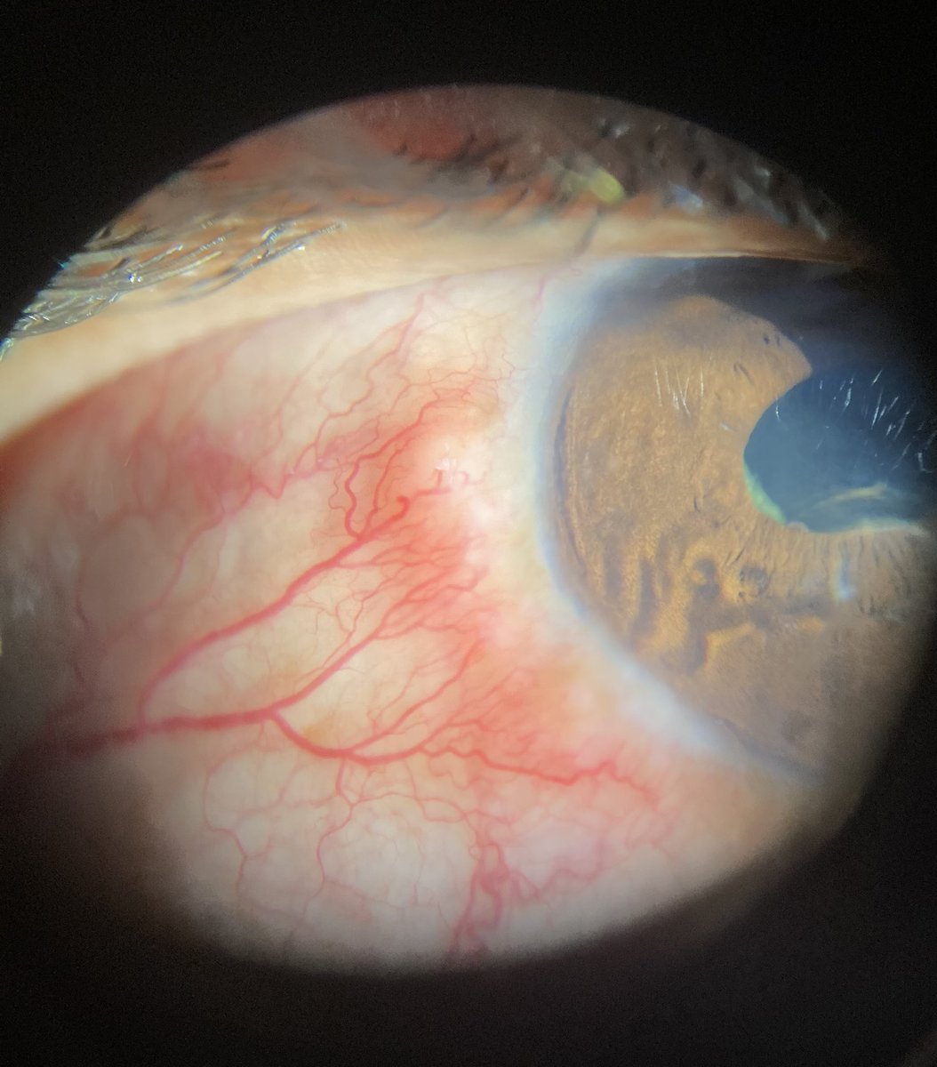 Steroid induced glaucoma presenting with inflammation every summer. 

Not tolerating cyclosporine. What next?

#MedTwitter #MedEd #Ophthalmology #glaucoma
