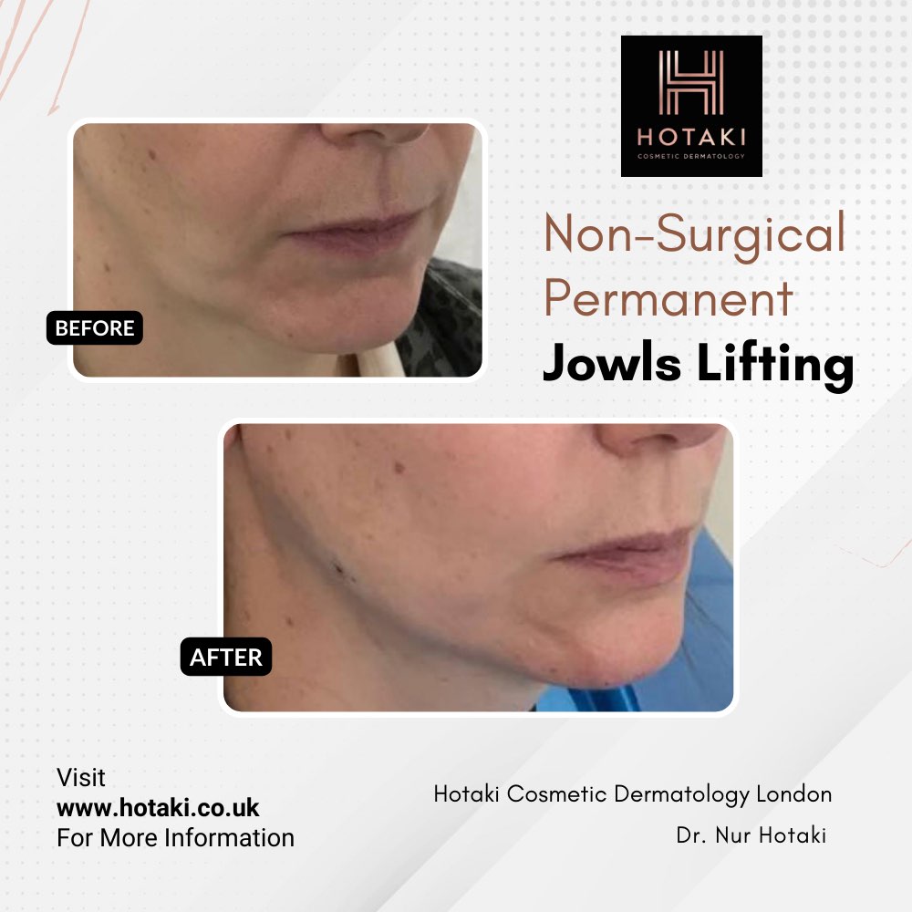 #drhotaki #hotakilondon #nonsurgicalaesthetics #aesthetictreatment #hotakicosmeticdermatology #noninvasive #nonsurgical #nonsurgicaljowlslifting #jowlslifting #jowlsliftingtreatment