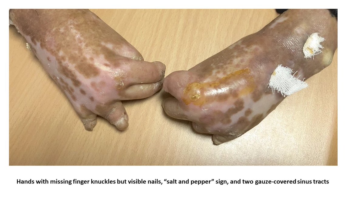 Severe acro-osteolysis in #SystemicSclerosis
👉rdcu.be/dJjKj