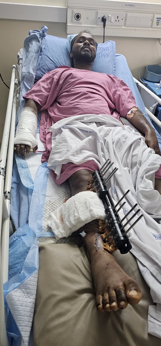 One of our JanaSainik Sai Ganesh, from Adoni, was involved in a bus accident on May 23,2024 and is presently undergoing several surgery in citizen hospital nallagandla. He has fully asserted his company's insurance claim, and he receives no additional financial assistance. Due to