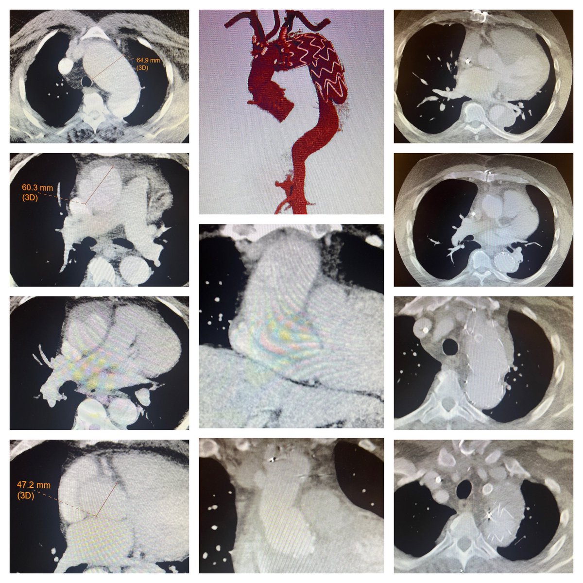 Quadragenarian with acute Stanford type A/DeBakey type I aortic dissection, root/ascending/proximal transverse arch #aorticaneurysm, uncontrolled hypertension, LVH, CKD stage 5 (preop GFR < 15; not yet on dialysis), BMI 44, OSA, treated with ascending/zone 2 arch replacement with