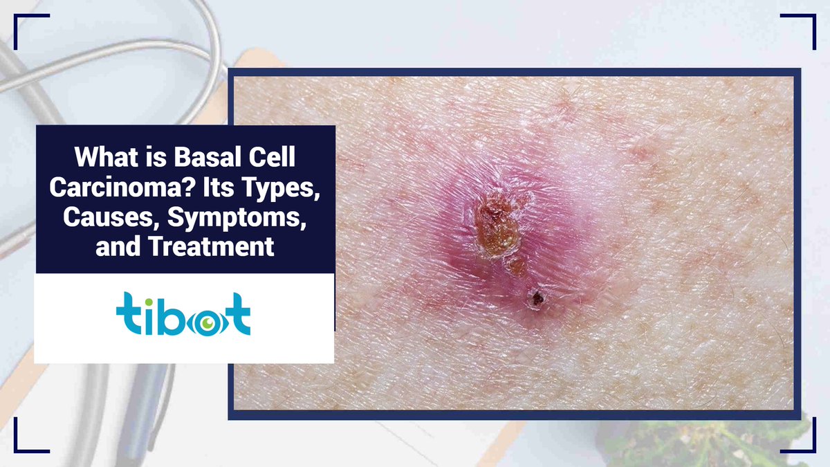 Basal Cell Carcinoma (#BCC) is the most common type of skin cancer, (Learn more: cutt.ly/5ey1ntZn) arising from the basal cells in the epidermis. While it rarely spreads to other parts of the body, early detection &treatment are crucial to prevent significant #skin damage.
