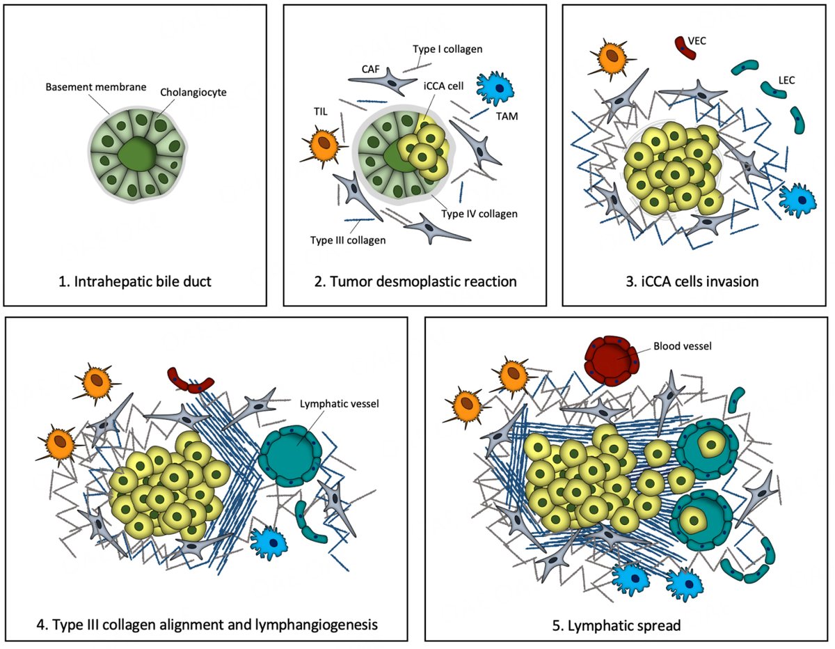 🔥Expression and function of #collagens in #intrahepatic #cholangiocarcinoma 📕Fibrillar collagens 📕Network-forming collagens 📕Beaded-filament-forming collagens 🖇️Full text: oaepublish.com/articles/2394-…