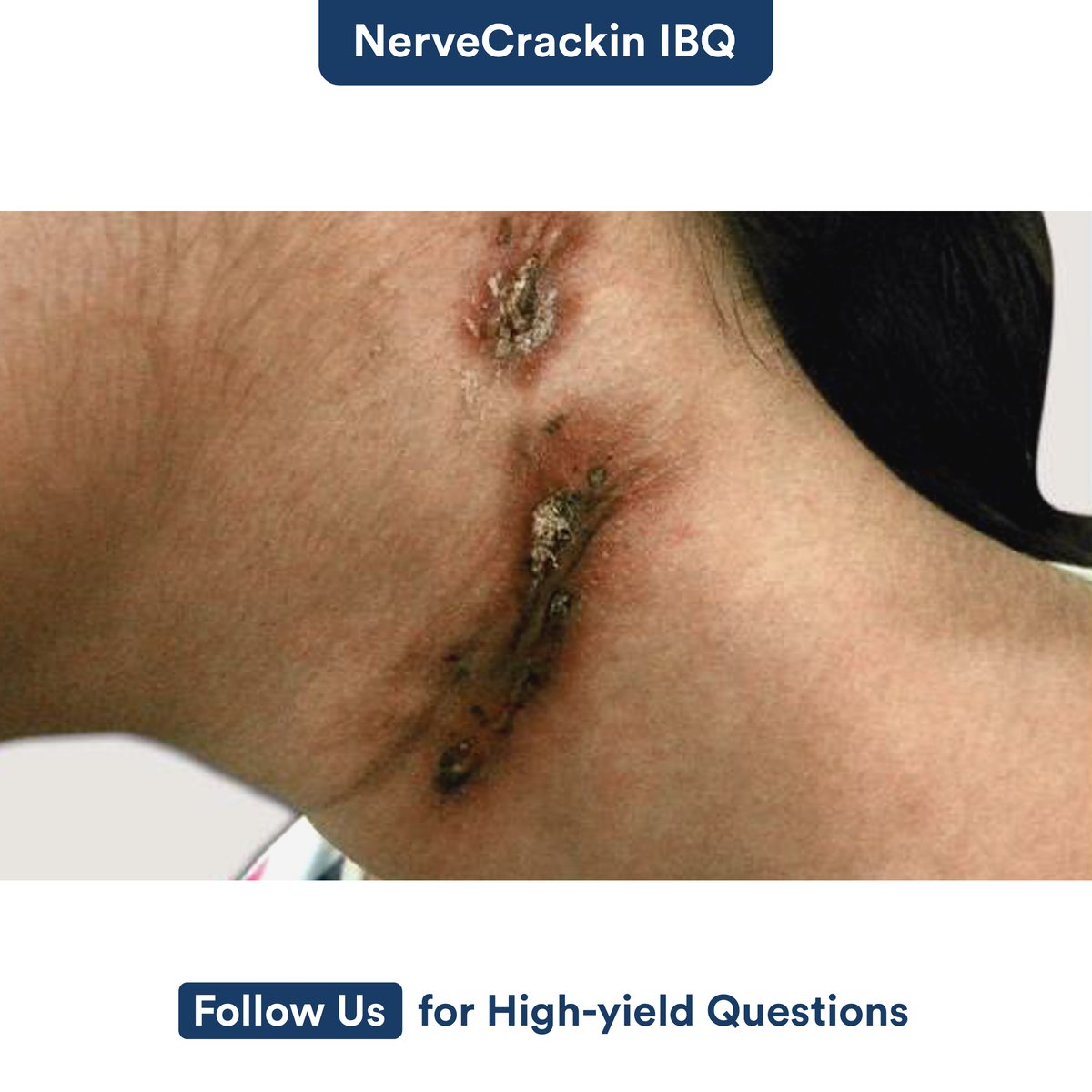 Which disease has been shown in this image? What is the most likely diagnosis?
 
A) Pyoderma gangrenosum  
B) Scrofuloderma  
C) Erysipelas  
D) Impetigo
 
#DigiNerve #IBQ #NerveCrackin #Impetigo #KnowledgeTest #ImageBasedQuestion #Pyoderma #gangrenosum #Erysipelas