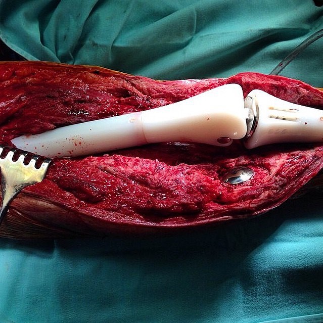 Prosthetic femur and tibia replacement due to an osteosarcoma of the bone