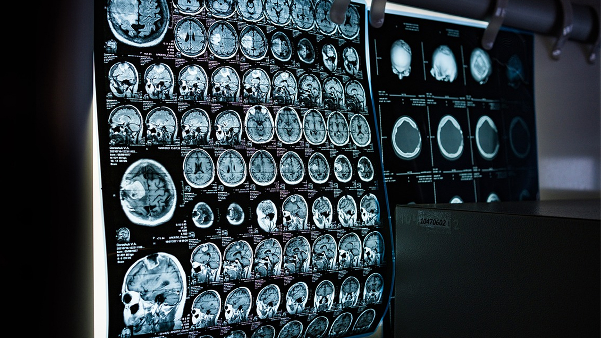 ¿Sabes cómo se puede mejorar el diagnóstico de las enfermedades neurológicas? En nuestro nuevo artículo en el blog de <a href="/Csalutec/">CSalutec</a> te lo contamos.

csalutec.com/mejorando-el-d…