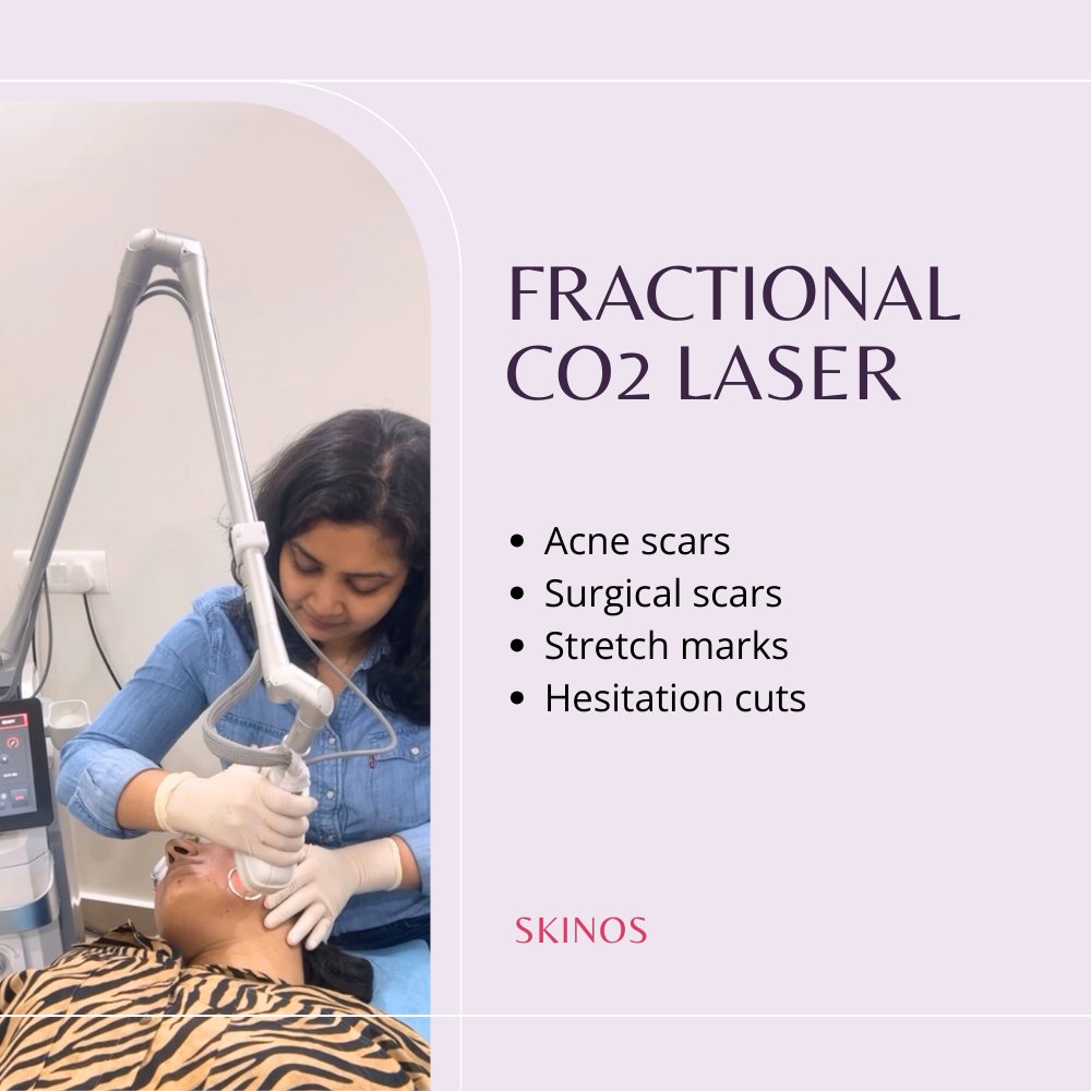 Experience radiant skin like never before with our CO2 Laser Treatment! ✨ Say goodbye to skin imperfections and hello to a flawless complexion. Learn more about the benefits and book your appointment today.

#CO2Laser #SkinCare #FlawlessSkin #Dermatologist #DrShrutiGupta