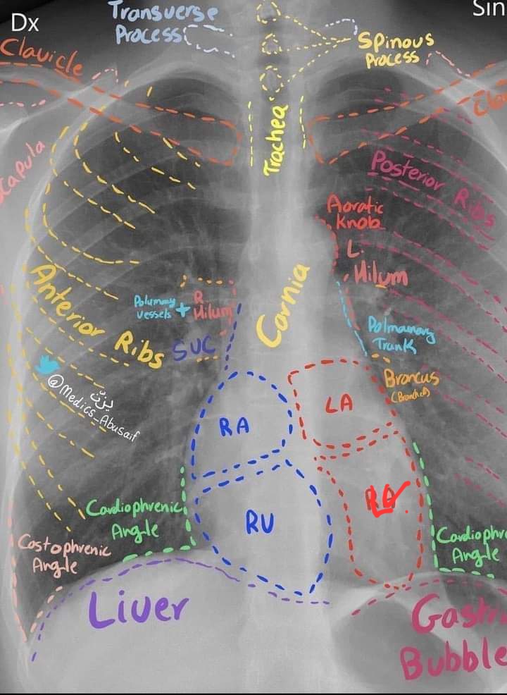 walinjom's tweet image. Master a Normal Chest X-ray