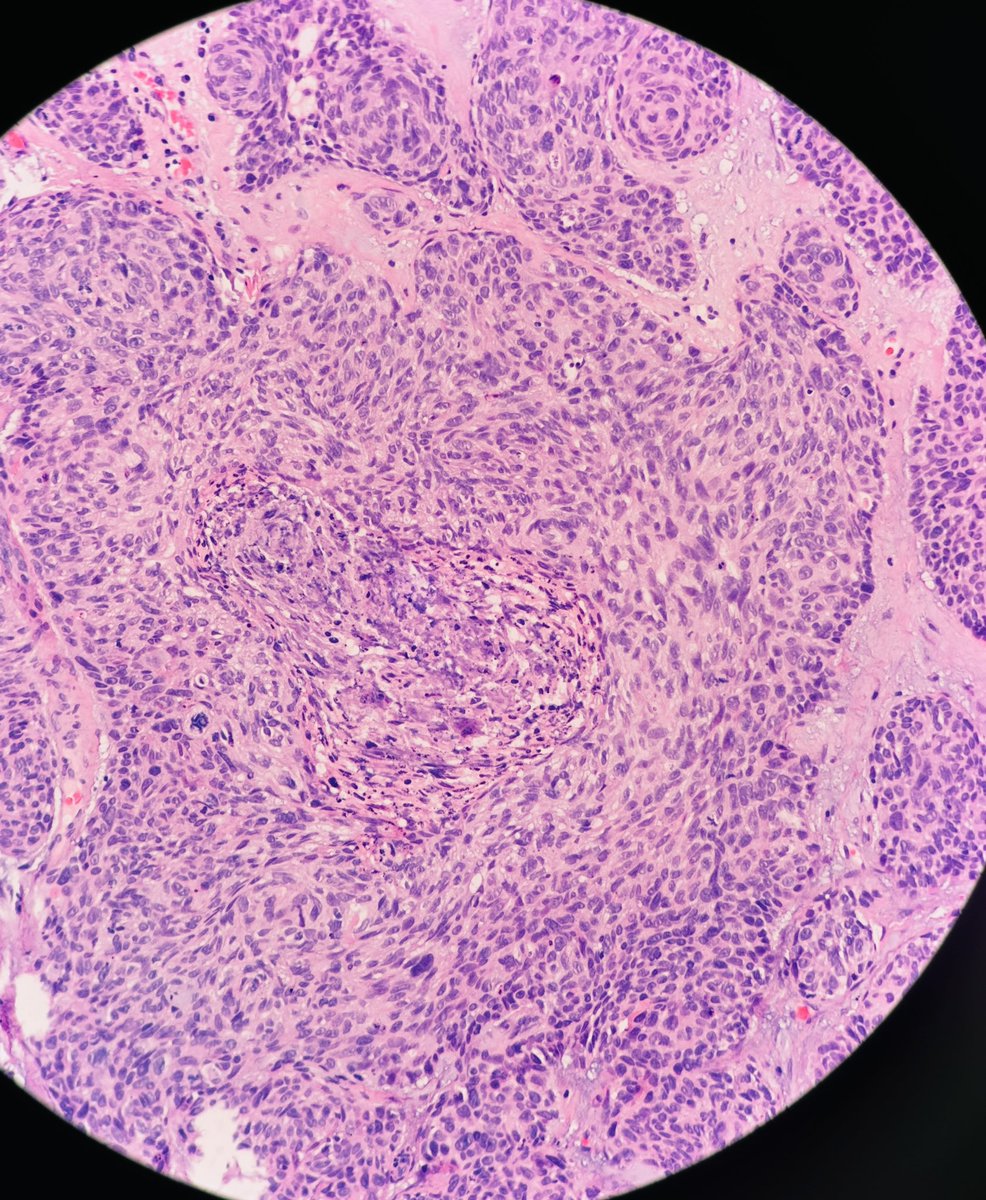 Elderly man cheek lesion #dermpath #pathology @ArjunRamaiya1 @PIorfino @kis_lorand @redsnapperpath @MarcelaSaebL @et565 @tonitatirado @SimonRoyMD @EssaoudiMohamed @gonzadetoro