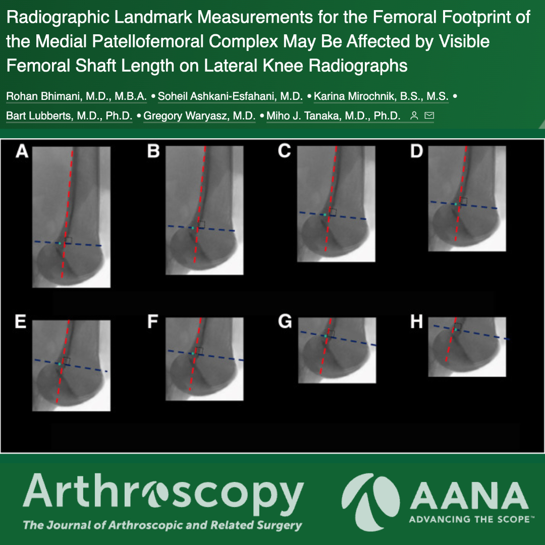 Radiographic Landmark Measurements for the Femoral Footprint of the Medial Patellofemoral Complex May Be Affected by Visible Femoral Shaft Length on Lateral Knee Radiographs #knee #MPFL @DrMihoTanaka