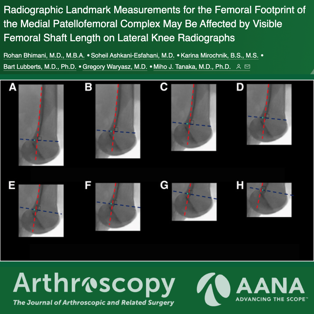 ArthroscopyJ's tweet photo. Radiographic Landmark Measurements for the Femoral Footprint of the Medial Patellofemoral Complex May Be Affected by Visible Femoral Shaft Length on Lateral Knee Radiographs #knee #MPFL @DrMihoTanaka https://t.co/5b0e0VhOcf