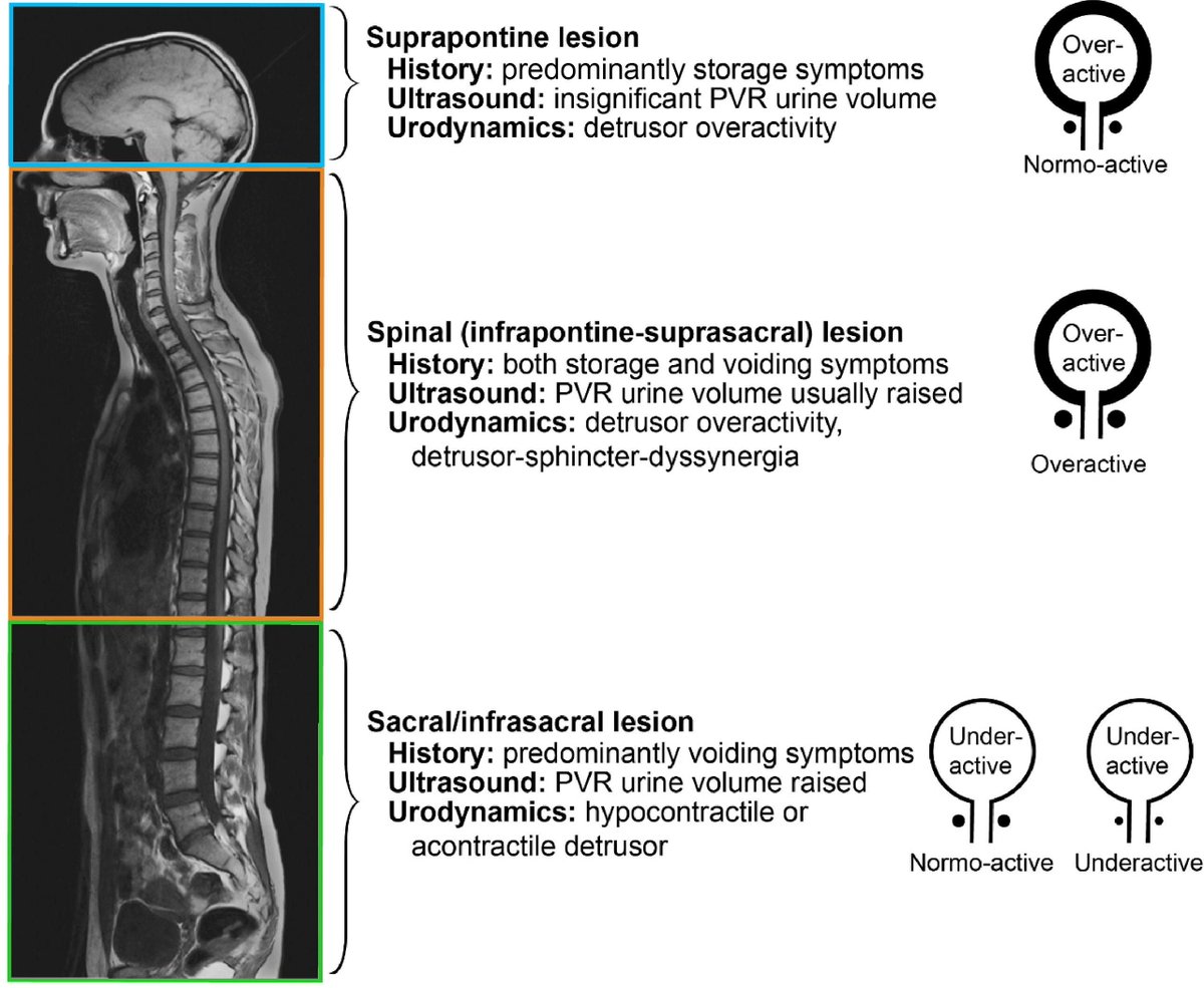 European Urology (@euplatinum) on Twitter photo Guidelines: Summary of the 2024 Update of the European Association of Urology Guidelines on Neuro-urology by Andrea M. Sartori et al.
Read the full article here: buff.ly/3URcZp6
<a href="/GiulioPopolo/">Giulio Del Popolo</a> @gilkarsenty <a href="/drmusco/">Stefania Musco</a> <a href="/bpadillafdez/">Bárbara Yolanda Padilla Fernández</a> <a href="/NatSchoutenEAU/">Natasha</a>
#UroSoMe #Medtwitter Guidelines: Summary of the 2024 Update of the European Association of Urology Guidelines on Neuro-urology by Andrea M. Sartori et al.
Read the full article here: buff.ly/3URcZp6
<a href="/GiulioPopolo/">Giulio Del Popolo</a> @gilkarsenty <a href="/drmusco/">Stefania Musco</a> <a href="/bpadillafdez/">Bárbara Yolanda Padilla Fernández</a> <a href="/NatSchoutenEAU/">Natasha</a>
#UroSoMe #Medtwitter