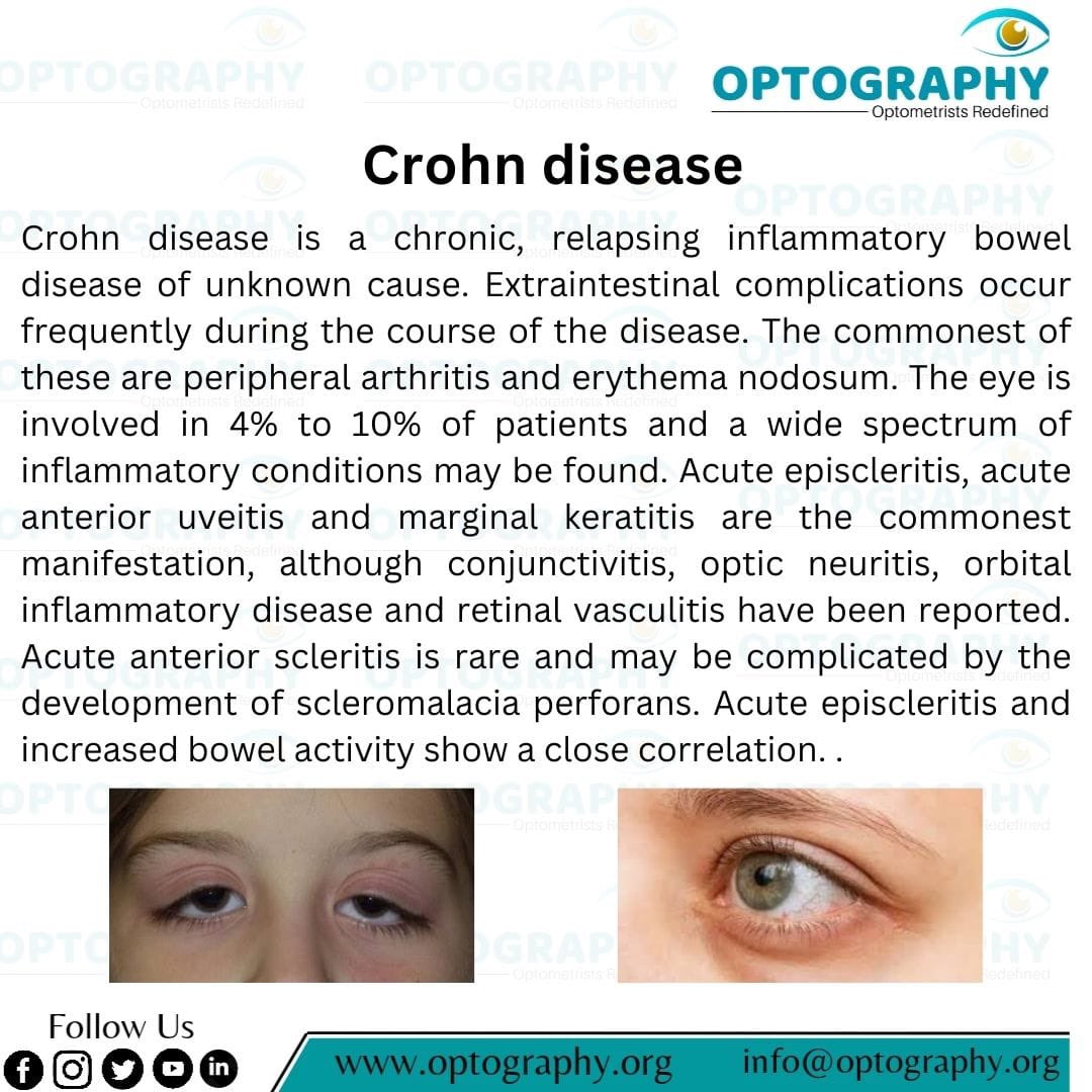 Optography8's tweet photo. #Crohndisease #Uveitis #Optpmetry #Optpmetrist #thatoptometrist
#Optography #Eyedisease https://t.co/F6siNZorGF