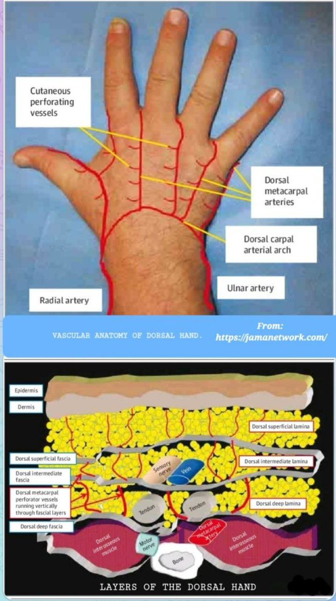 Skin of distal 1/3 of hand & proximal digits supplied by perforating from palmar arterial system. Common digital arteries, from superficial palmar arch,AS WELL AS,palmar metacarpal arteries from deep palmar arch connect with dorsal metacarpal arterial system&give off perforators