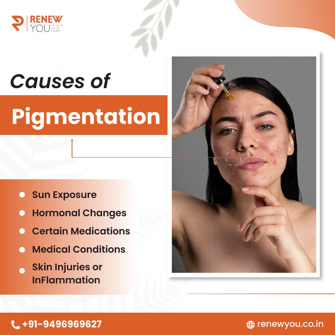 Get the pigmentation treatment done on time! 
.
.
.
.
.
.
#hyperpigmentation #unevenskintone #skincare #beautyhacks  #clearskin #glowingskin #skinbrightening #selfcare #healthylifestyle  #explorepage #lifestlye #health #skincare #haircare #dailytips #tips #health  #renewyouclinic