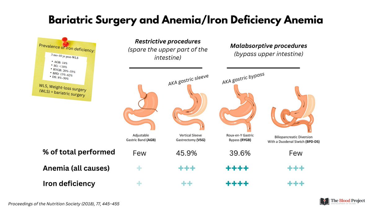 1/5

BARIATRIC SURGERY AND IRON DEFICIENCY ANEMIA (IDA)

A) DEFINITIONS:  

Bariatric surgery = weight loss surgery, includes:  

1. Gastric band 
2. Gastric sleeve 
3. Gastric bypass
