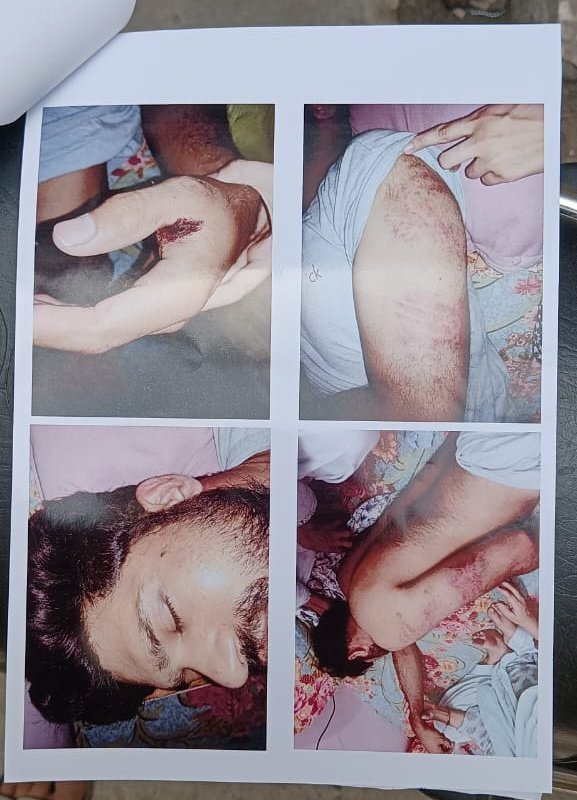 ZakirAliTyagi's tweet photo. दिल्ली के विनोद नगर निवासी आरि���़ को पुलिस ने इतनी बेरहमी से पीटा है कि बात उसकी जान पर बन आई है, आरिफ़ ने दिल्ली पुलिस के SHO अरुण कुमार सहित सभी पुलिसकर्मियों पर मुस्लिम होने की वजह से "मुल्ले, कटुवे, " कहते हुए बेरहमी से पीटने व उसके गुप्तांगों को गंभीर चोट पहुंचाने का भी आरोप लगाया है!

आरिफ़ ने प्रार्थना पत्र के माध्यम से बताया कि 21 मई को जैसे ही वह घर से निकला कुछ ही दूरी पर उसे पुलिसकर्मियों ने रोक लिया उसकी बाइक पर नंबर प्लेट ना होने के कारण नाम पूछा और बेरहमी से पीटते हुए थाने ले गये और पिछले भवन में उसे पुलिस ने बांधते हुए उसके साथ मुल्ले, कटुवे कहते हुए बेरहमी से मारपीट की गई व उसके गुप्तांगों को भी गंभीर चोट पहुंचाई गई है, वह अस्पताल में भर्ती रहा लेकिन पुलिस ने उसे जल्दी डिस्चार्ज करा दिया व अब उसकी हालत गंभीर बनी हुई है!

@HMOIndia @LtGovDelhi आपकी @DelhiPolice एक नंबर प्लेट ना होने के लिए गैरकानूनी तरीके से देश के नागरिक की इस क़दर जान लेने पर तुली है कि इस व्यक्ति को पीटते हुए अधमरा कर दिया , तस्वीरें व वीडियो सारी कहानी बयां कर रही है कि SHO अरुण कुमार ने पीड़ित को थाने के पिछले भवन में ले जाकर कितनी बेरहमी से उसको क़त्ल करने की नीयत से पीटा है, आपसे निवेदन है कि तस्वीरों व वीडिओज़ और पीड़ित की गवाही को साक्ष्य मानते हुए जांच कर दोषी पुलिसकर्मियों पर त्वरित कार्यवाही होनी चाहिए!