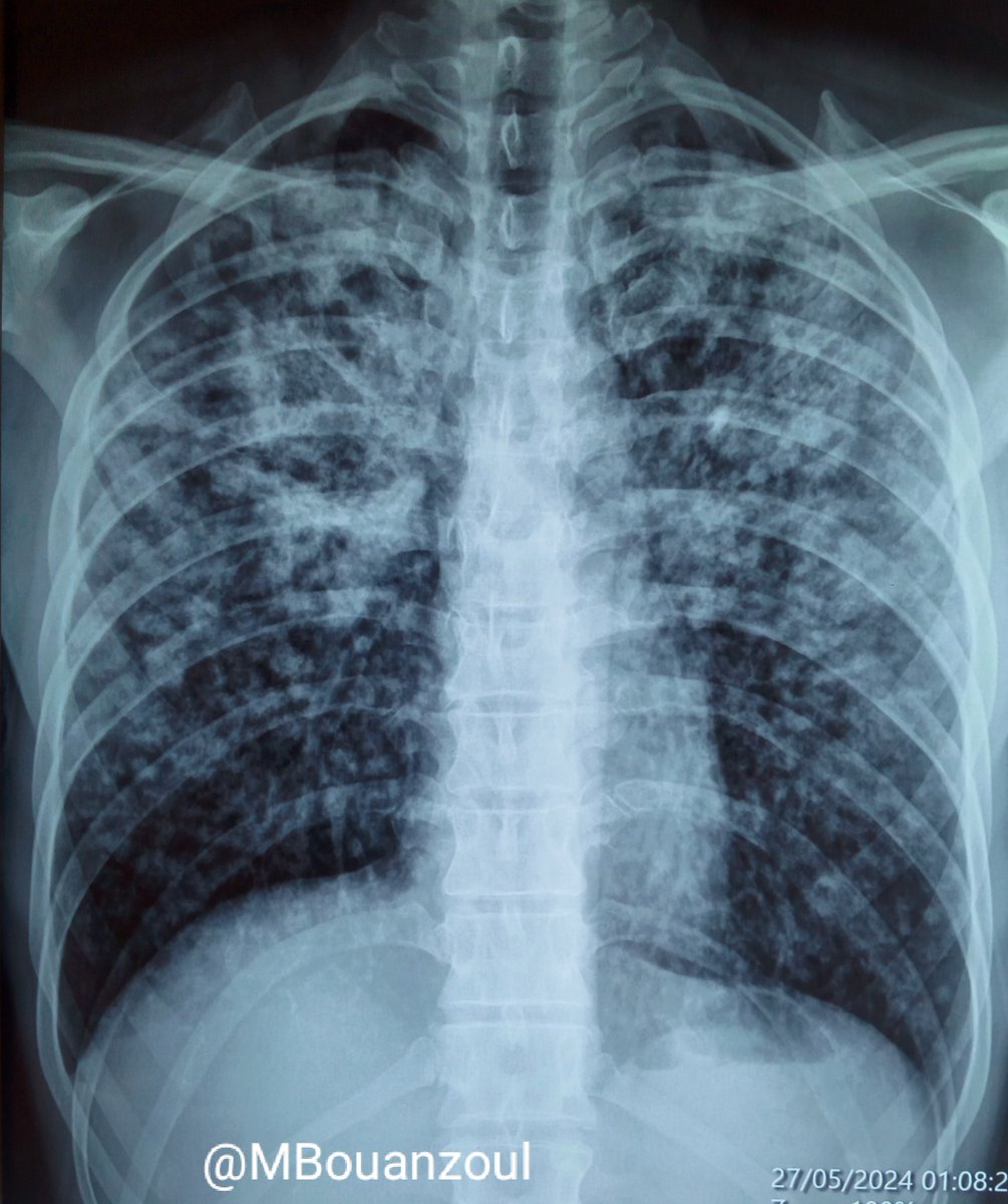 MBouanzoul's tweet image. Sharing a chest radiograph of a pulmonary tuberculosis in a 42-year-old man presenting with cough and malaise. Rapid sputum exam was positive. HIV testing was negative. 
#tuberculosis #chestrad #PulmCCM #radres