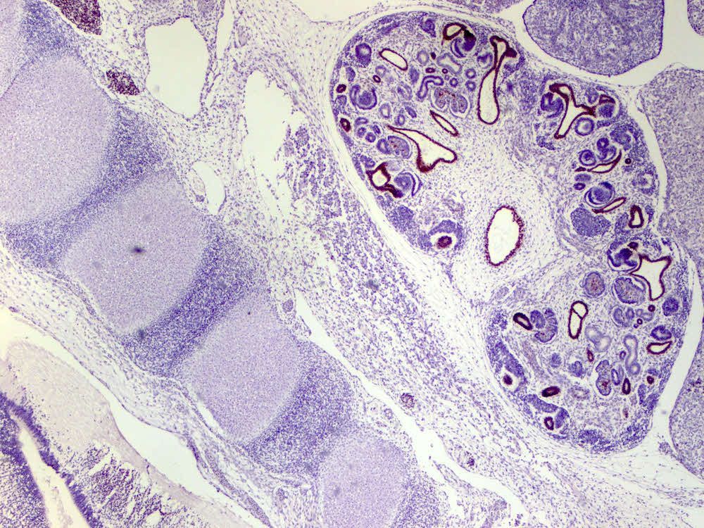 Image of the Week!

Submitted by: Mariia Ivanova, M.D., Ph.D.
Directory Profile: buff.ly/3KoAq4g
Subspecialty: Medical renal
Diagnosis: GATA3 normal expression in fetal kidney

#PathTwitter #PathX #PathologyOutlines #Image #Kidney