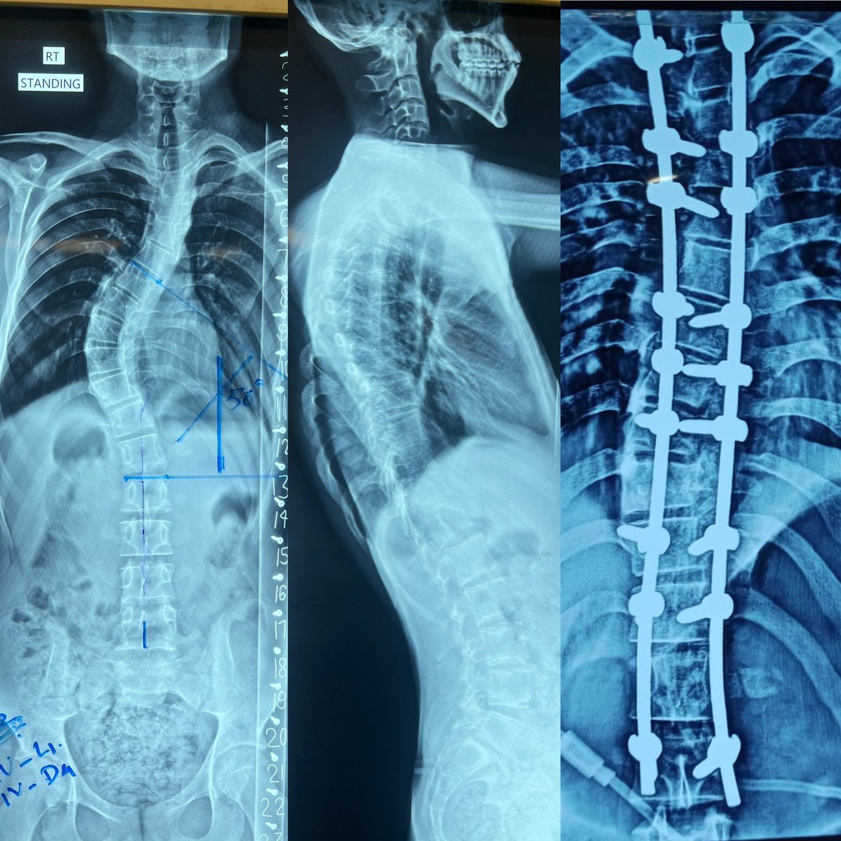 Segmental Spinal Instrumentation D2- L2  in a 14 years boy having adolescent Idiopathic scoliosis (AIS). #Orthotwitter #Medtwitter #spine
