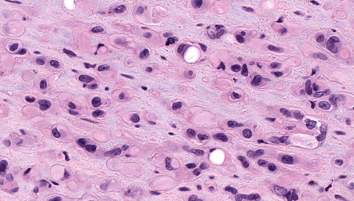 30 F. Mass in lumen of femoral vein. Diagnosis? WSI digital slides: kikoxp.com/posts/21727 Immunostains: kikoxp.com/posts/21729 Answer & Video: youtube.com/watch?v=9pBgqd… #pathology #pathologists #pathTwitter #dermpath #dermatology #dermatologia #dermtwitter #BSTpath