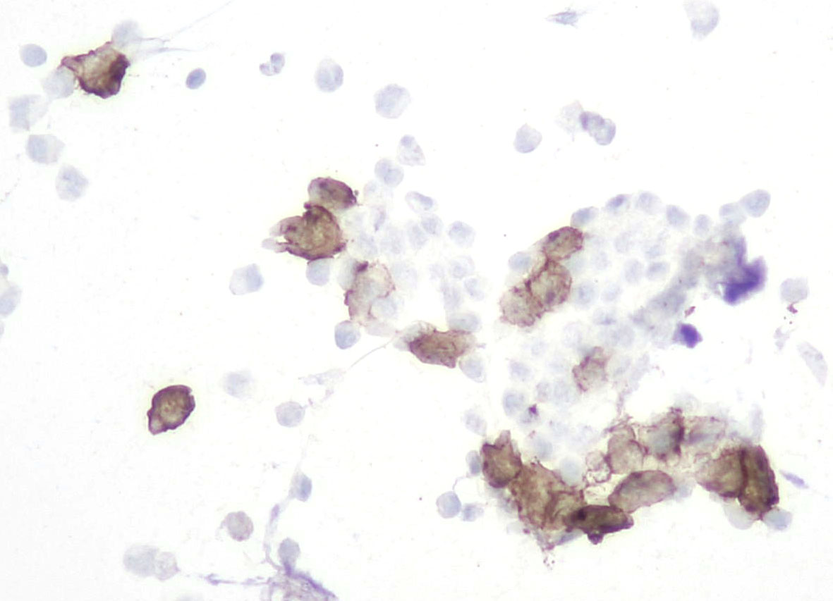 Impressive CSF 🧐🔬from a patient with multiple myeloma. 
Plasmacytoid (tumor) cells mixed with other inflammatory cells.  
Mitosis (red arrow) 
ICC on pap-stained smear with CD138 (plasma cell marker) 
#Cytopath @EfcsYoung @SECitologia @IACytology