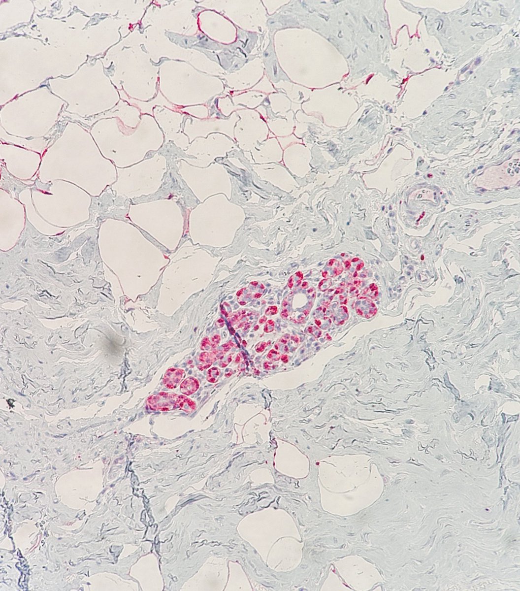 S100

• Stains Schwann cells and melanocytes 
• Stains Adipocytes
• Stains (I often forget) myoepithelial cells in breast too 👇 

#pathagonia #path4people #pathx #ihc #s100 #pathtwitter #breastpath