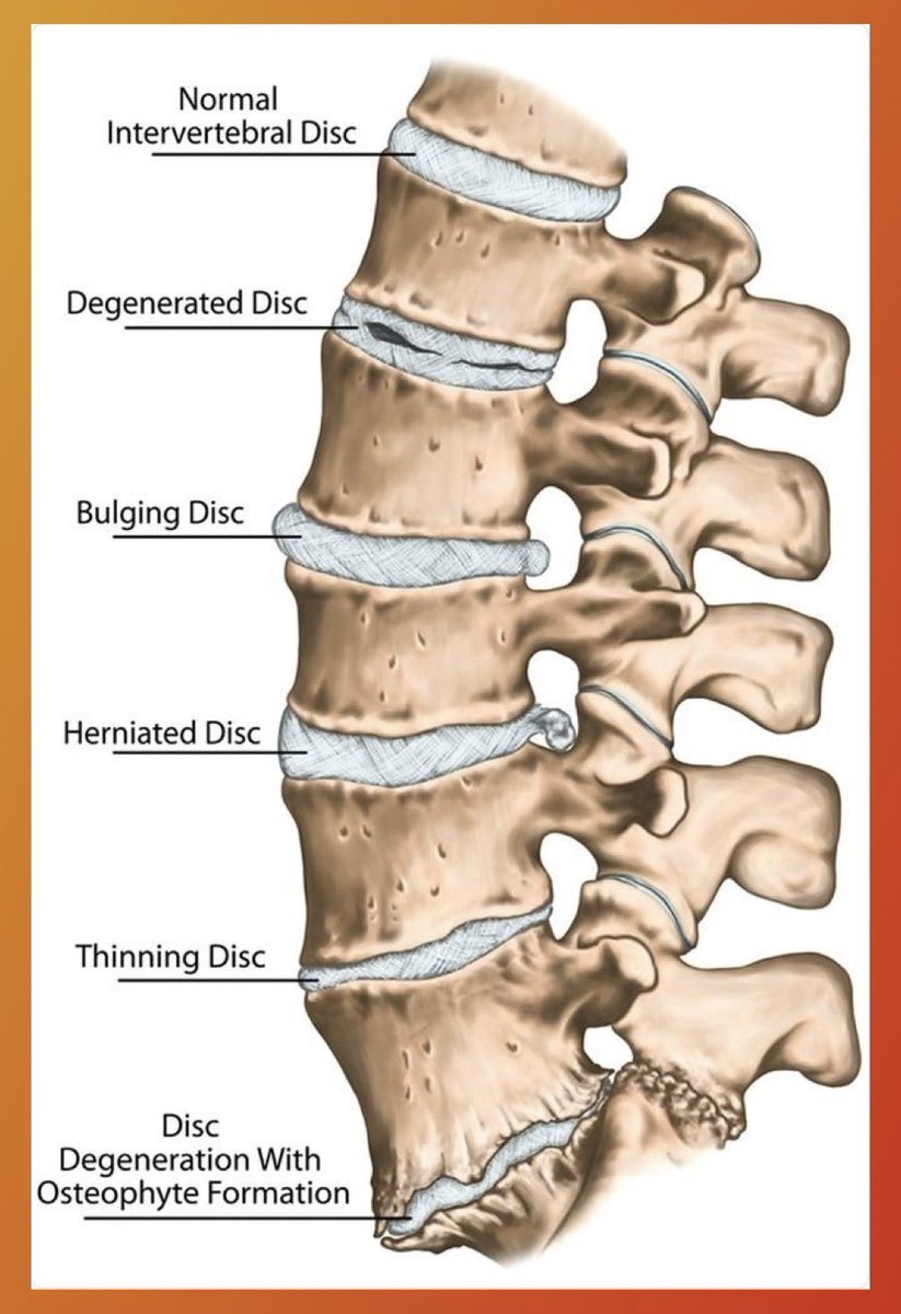 Spondylosis, Spondylolysis, and Spondylolisthesis youtu.be/e0zzNL9pIuY