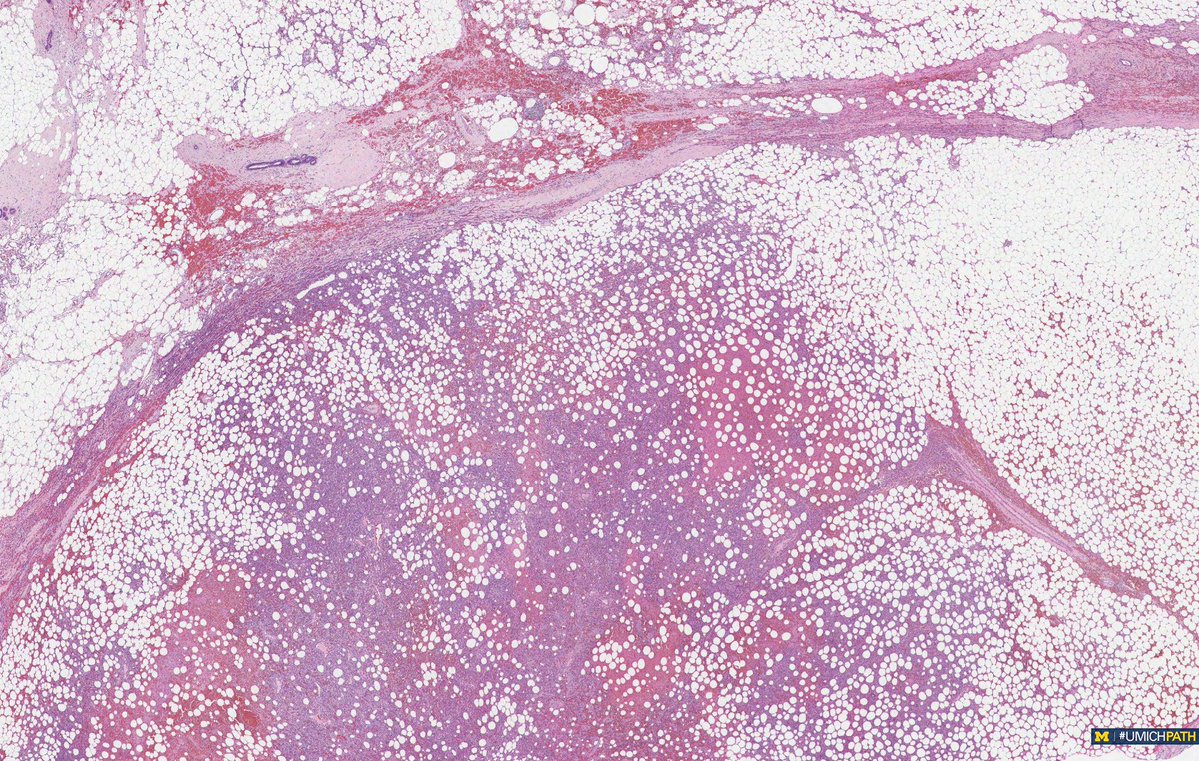 🔬#COTW by @MeredithKHerman!
A 62-year-old female with dx of breast cancer who presents with lymphedema and new breast lesion.
What top 2 stains would you order to confirm the diagnosis? What is the diagnosis?
#PathX #UMichPath #BreastPath