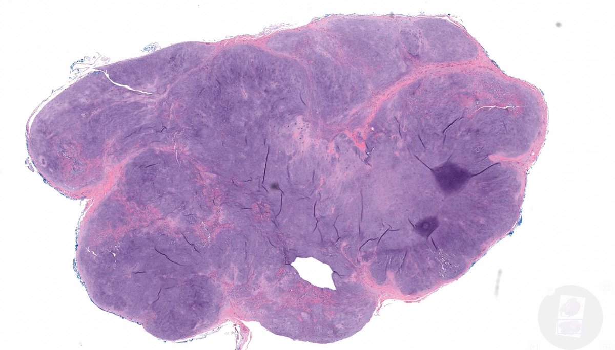 50 yo woman with nodule on foot. WSI digital slide: kikoxp.com/posts/8268. Answer & video: youtube.com/watch?v=eJ2dpq… #BSTpath #pathologists #pathology #pathTwitter