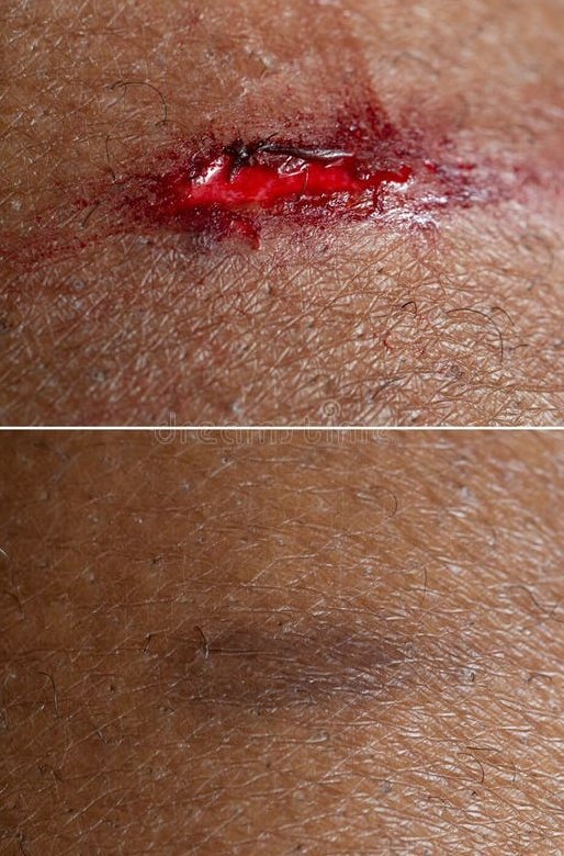 Nig_Farmer's tweet image. #NaijaFarmerTips

I was at the gym few days ago and I hurt my finger. I was replacing a kit &amp;amp; my hand slipped tearing my finger and causing serious pain.

Are you a sports person who gets injured, or children even farmers who sometimes get injured on the farm. If you're a handy…