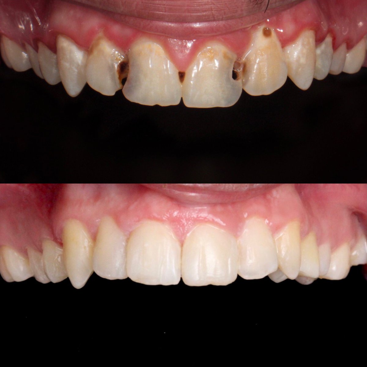 dalia_mr77's tweet photo. And finally, concluding this thread with my last case as an undergrad student : an Esthetic Case of Direct restorations and resin infiltration. 

Special thanks to @RashaHaridy1 for the outstanding and highly informative elective course.The insights gained were invaluable 💕 https://t.co/LCOQIUZVfV