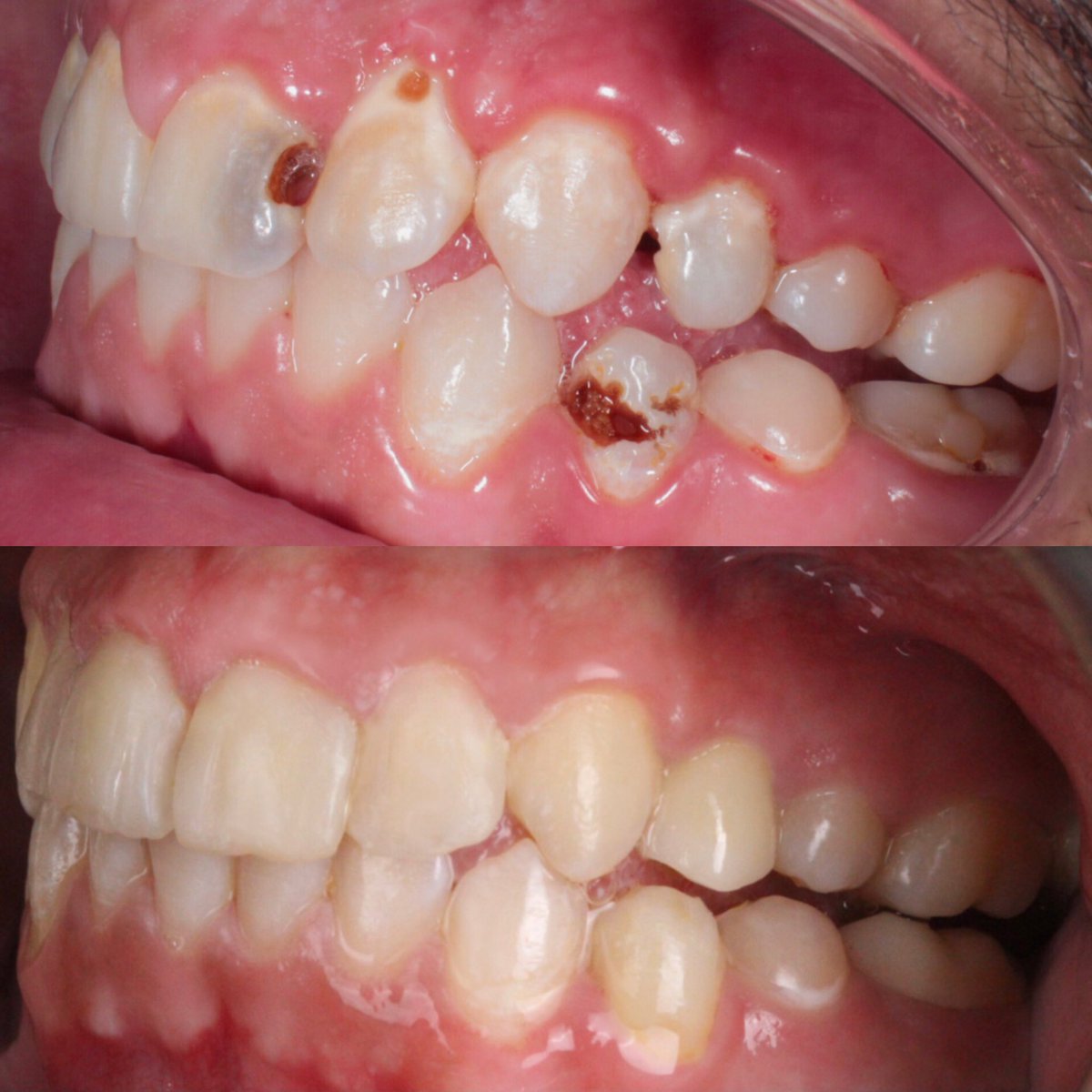 dalia_mr77's tweet photo. And finally, concluding this thread with my last case as an undergrad student : an Esthetic Case of Direct restorations and resin infiltration. 

Special thanks to @RashaHaridy1 for the outstanding and highly informative elective course.The insights gained were invaluable 💕 https://t.co/LCOQIUZVfV