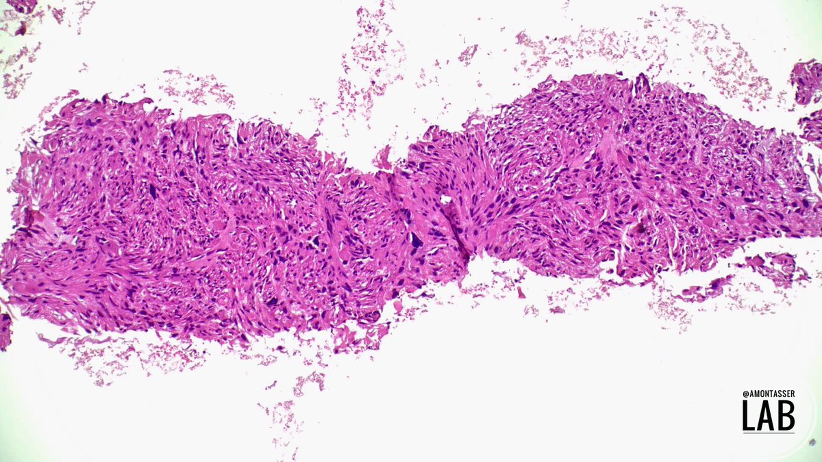 M 60+ 

🔬 Retroperitoneal LMS: cellblock of EUS-FNB

#Pathology #BST #PathTwitter #PathX
