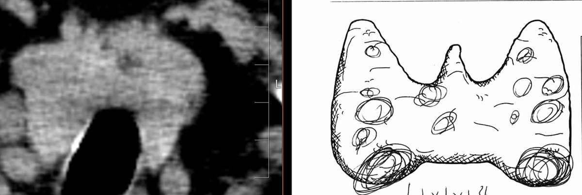 If you see a thyroid nodule on a chest CT please do EVERYONE a favor and ignore it. Do not rec thyroid US.