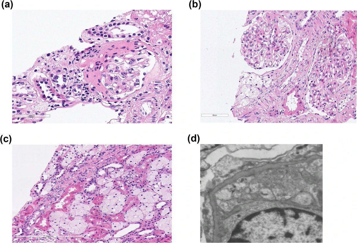 Ped_Neph's tweet photo. Alport syndrome is a genetically heterogenous disorder thought to be affecting only males. Read these Clinical Insights into a 15-yr-old female w/a rare pathogenic variant in the COL4A5 gene &amp; X-linked Alport syndrome. #OpenAccess
https://t.co/N4jEOxeFtQ https://t.co/QWRkorscgX