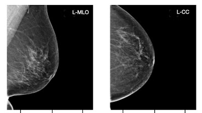 A Semiautonomous Deep Learning System to Reduce False-Positive Findings in Screening Mammography doi.org/10.1148/ryai.2… @whiterabbitai #DeepLearning #AI #ML