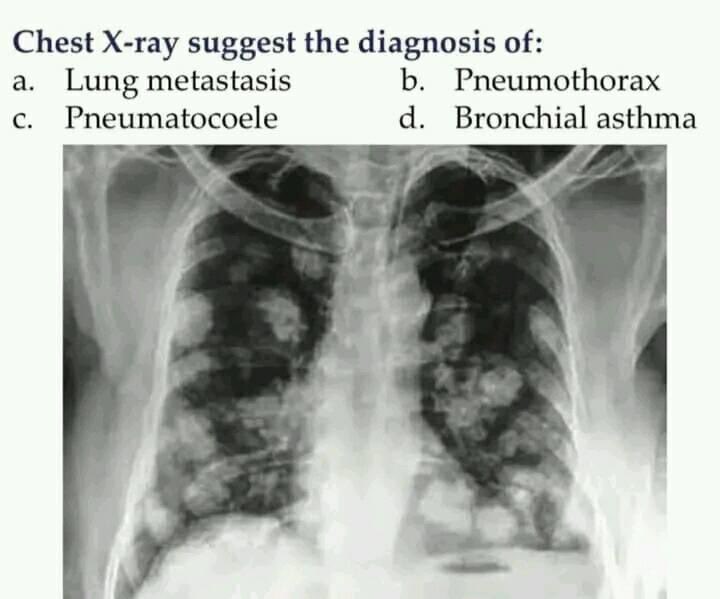 #MCQ
Chest X-ray suggest the diagnosis of:
a. Lung metastasis
b. Pneumothorax
c. Pneumatocoele
d. Bronchial asthma

#MedEd 
#MEDHM 
#MedX 
@IhabFathiSulima