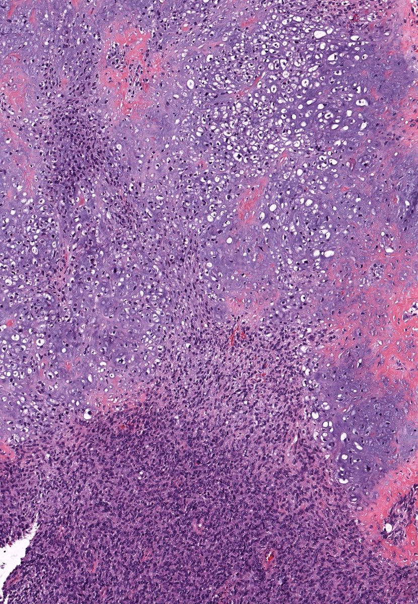 60 yo M. Face. Diagnosis? WSI digital slide: kikoxp.com/posts/11795 Stains: kikoxp.com/posts/11806 Answer: youtube.com/watch?v=JyB18Q… #pathology #pathologists #pathTwitter #dermpath #dermatology #bstpath #dermtwitter