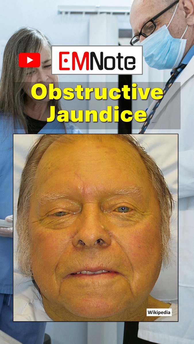 Obstructive Jaundice. youtube.com/shorts/mymLpGV… Causes of obstructive jaundice can be classified as intraluminal, transmural, or extraluminal.