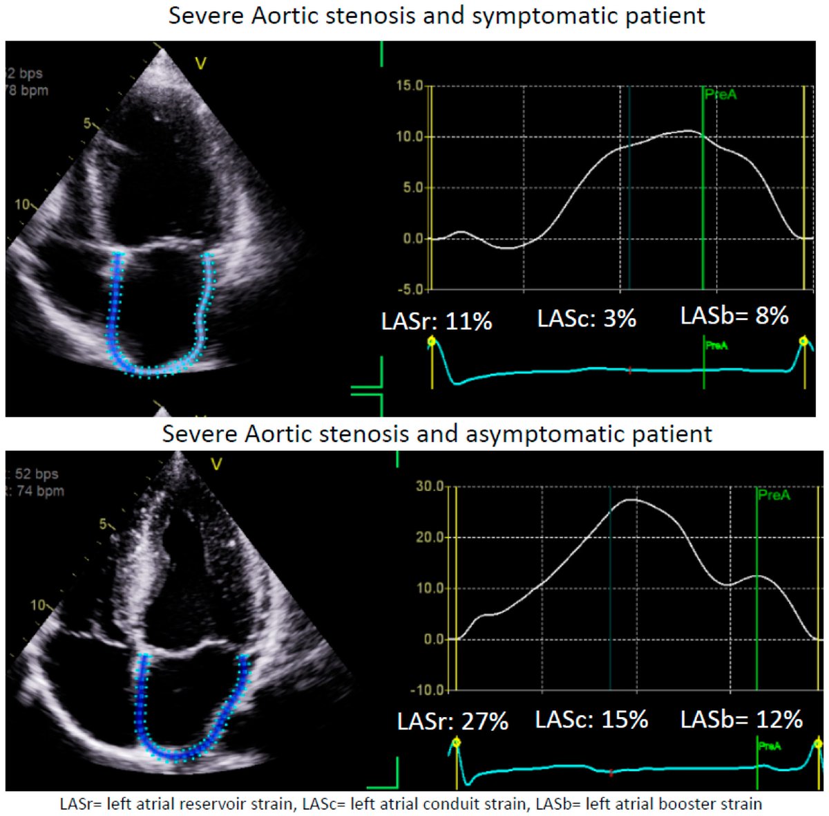 🔴The Clinical Applications of Left Atrial Strain: A Comprehensive #OpenAccess #2024Review

✅mdpi.com/1648-9144/60/5…
#CardioEd #EchoFirst #echofirst #CardioTwitter #FOAMed #MedEd #MedTwitter #Emergency #residents #Students #medicaleducation #medicalstudent #icu #CriticalCare