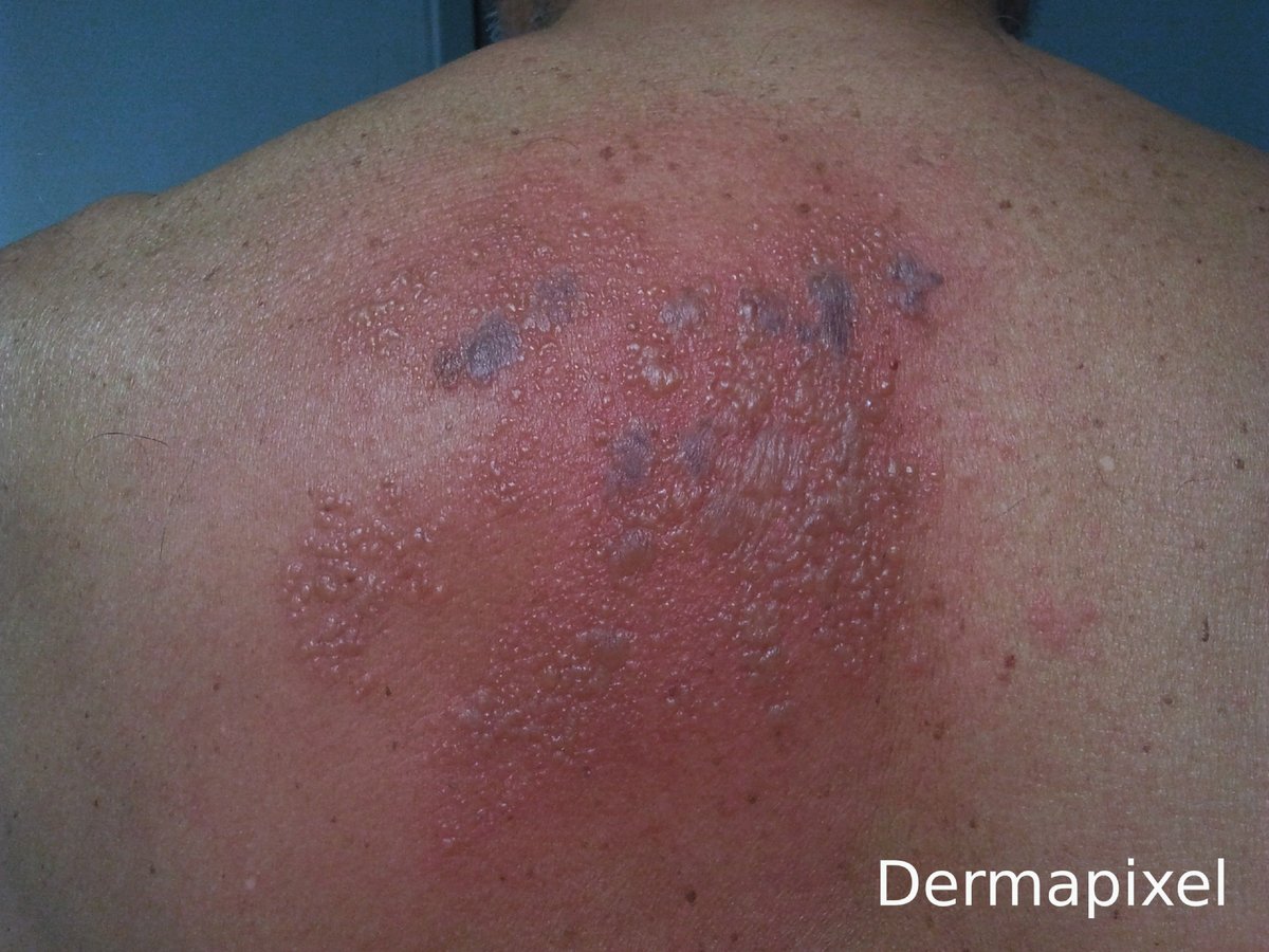 Rosa Taberner (@rosataberner) on Twitter photo Hoy en <a href="/dermapixel/">Dermapixel</a> hablamos de la vacuna del herpes zoster.
dermapixel.com/2024/05/herpes…
#dermatología #dermtwitter #dermatology Hoy en <a href="/dermapixel/">Dermapixel</a> hablamos de la vacuna del herpes zoster.
dermapixel.com/2024/05/herpes…
#dermatología #dermtwitter #dermatology