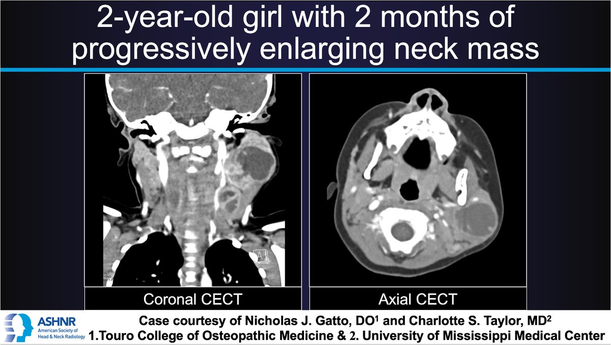 ASHNRSociety's tweet photo. #ASHNRCOTW #255: Neck mass. Thx @NicholasJGatto, @CSTaylor + @UMMCRads 4 case!  #ASHNR24            

Answer w/ appropriate GIF only -- stay professional &amp; don't spoil it!

@callyrobs @DShatzkes @CDP_Rad @rhwiggins
@nakoontz @KRileyMD @CMGlastonbury @cmtomblinson @tabby_kennedy https://t.co/z455RUmJka