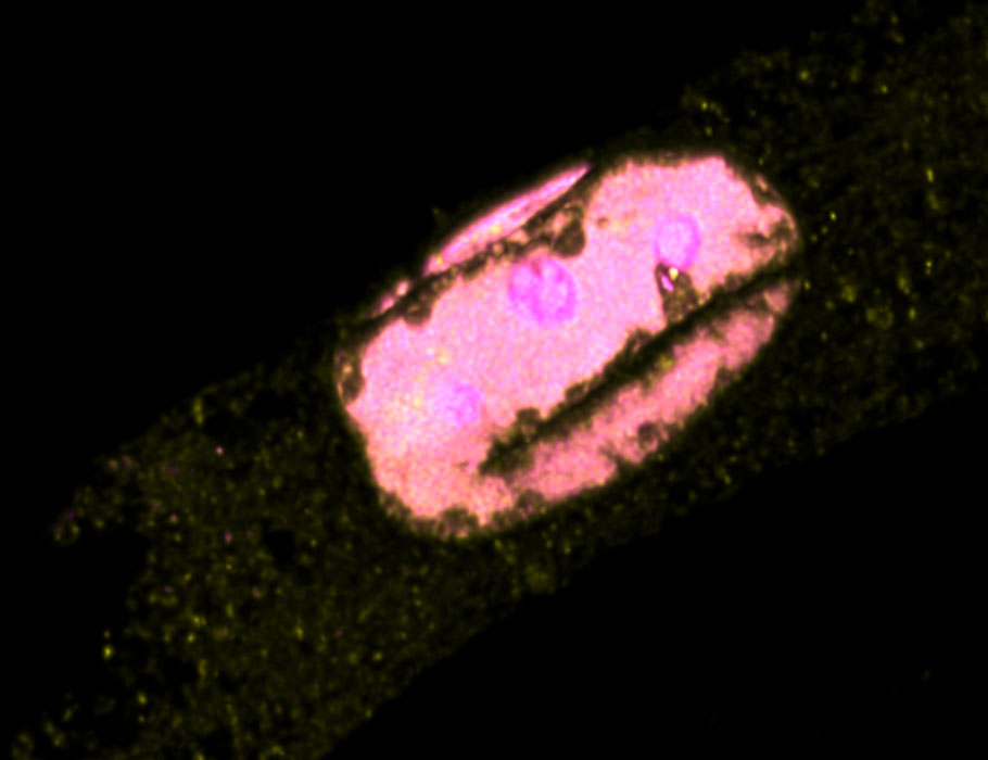 A single gene mutation, common to 11 pediatric patients with either #SCID or #OmennSyndrome, could one day offer clinicians an early window to diagnose and treat these inborn errors of #Tcell development. <a href="/UniofNewcastle/">Newcastle University</a> scim.ag/787