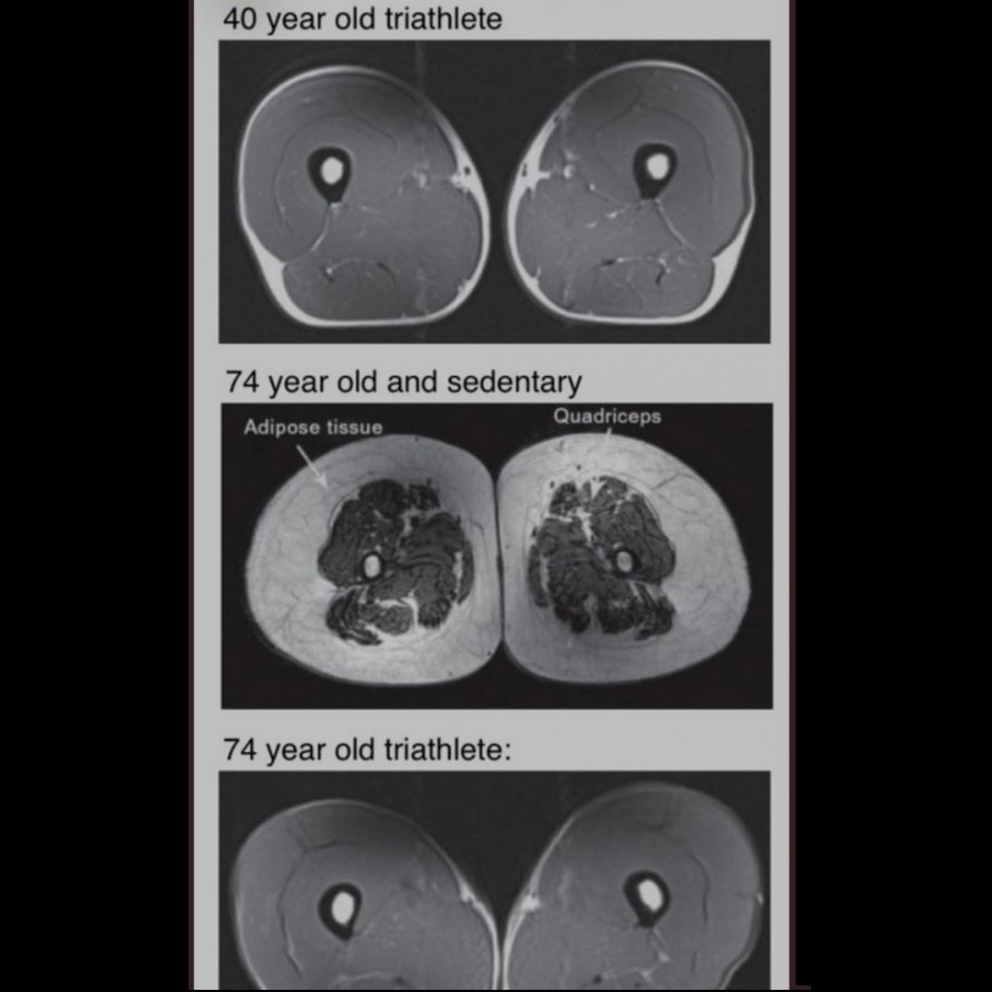 It's not because she is old.

It's because she is sedentary.

h/t <a href="/hjluks/">Howard Luks MD</a>