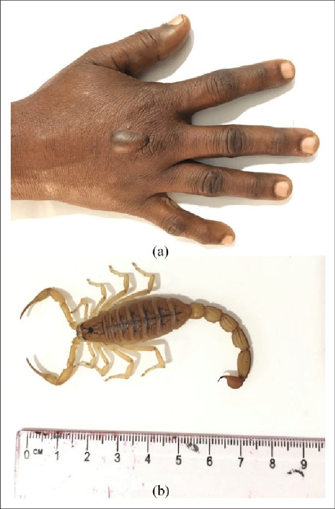 🍁𝘾𝙇𝙄𝙉𝙄𝘾𝘼𝙇 𝙌𝙐𝙄𝙕:-

Which of the following prevents cardiopulmonary complications in scorpion bite?

A.  Inj. antivenin 
B.  Local infiltration of lignocane 
C.  Corticosteroid 
D.  Prazosin

#medx
#medEd