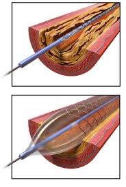 In recent years, I see in my vascular clinic an expansion in the use of some of the recent endovascular techniques including peripheral angioplasties using stents, dilatation balloons for peripheral arterial disease; as well as venous endovascular procedures like venous ablation
