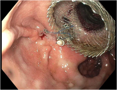 GIE (@gie_journal) on Twitter photo Article in Press: โFixation of proximal flange of LAMS using through-the-scope suturing system to prevent stent migration in single-session EDGE" by Hafiz Muzaffar Akbar Khan et al. giejournal.org/article/S0016-โฆ
<a href="/AzharGastro/">Azhar Hussain</a> <a href="/MuzaffarAkbar/">Hafiz Muzaffar Akbar Khan</a> <a href="/Dr_VishnuKumar/">Vishnu Kumar</a> <a href="/DrHasan_Orlando/">MK Hasan</a> <a href="/DennisYangMD/">Dennis Yang, MD, FACG,AGAF,FASGE</a> Article in Press: โFixation of proximal flange of LAMS using through-the-scope suturing system to prevent stent migration in single-session EDGE" by Hafiz Muzaffar Akbar Khan et al. giejournal.org/article/S0016-โฆ
<a href="/AzharGastro/">Azhar Hussain</a> <a href="/MuzaffarAkbar/">Hafiz Muzaffar Akbar Khan</a> <a href="/Dr_VishnuKumar/">Vishnu Kumar</a> <a href="/DrHasan_Orlando/">MK Hasan</a> <a href="/DennisYangMD/">Dennis Yang, MD, FACG,AGAF,FASGE</a>