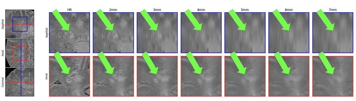 Excited to be back in Nashville for #CMSC2024 ! I'll be presenting our work looking at which resolutions the central vein sign can still be visible in 2D acquired T2*-weighted scans.

Come join my talk at its new time at 3:40pm in Room 207 BCD!